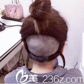 用的是我后腦勺的毛囊