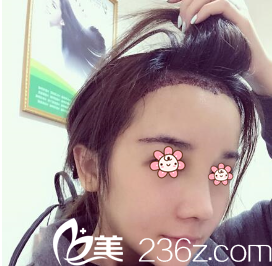 王昌林發(fā)際線調(diào)整術(shù)后第八天