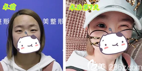 晶美朱博眼綜合7天術(shù)前術(shù)后對比案例 晶美朱博眼綜合7天術(shù)前術(shù)后對比案例