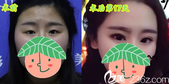 晶美石良兵院長眼綜合17天術(shù)前術(shù)后對比案例效果展現(xiàn) 晶美石良兵院長眼綜合17天術(shù)前術(shù)后對比案例效果展現(xiàn)