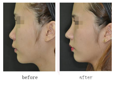 許政鼻部整形真人案例對比 許政鼻部整形真人案例對比