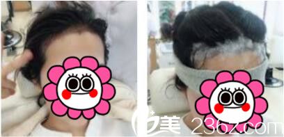 韓國江南藝麗人植發(fā)醫(yī)院李承宰發(fā)際線種植術(shù)后第三天