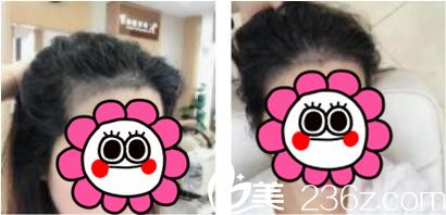 韓國江南藝麗人植發(fā)醫(yī)院李承宰發(fā)際線種植術(shù)后第七天