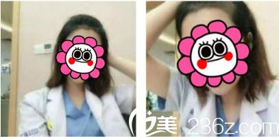 韓國江南藝麗人植發(fā)醫(yī)院李承宰發(fā)際線種植術(shù)后三個月