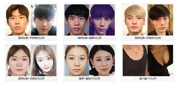 韓國諾寶絲整形醫(yī)院案例對比效果 韓國諾寶絲整形醫(yī)院案例對比效果