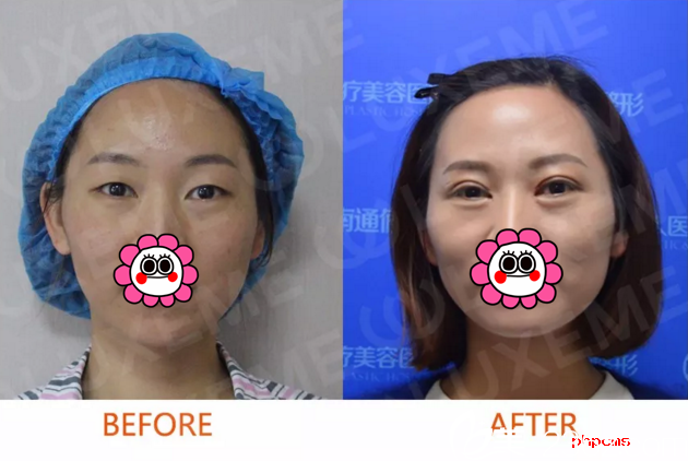 不想做切開嫌術(shù)后恢復(fù)慢還有疤痕 南通儷人連天美朱如崗為我設(shè)計了埋線法術(shù)后半個月自然成型