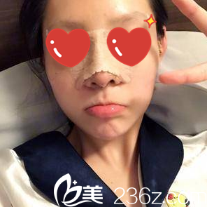 在美藝做假體隆鼻+脂肪填充面部第三天