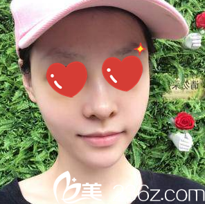 假體隆鼻+自體脂肪填充面部一周拆線