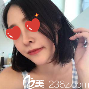 美藝自體脂肪填充+隆鼻一個(gè)月