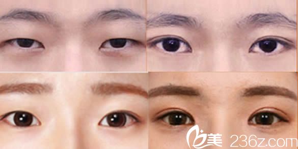 韓國然美之整形醫(yī)院李東勛院長雙眼皮案例圖