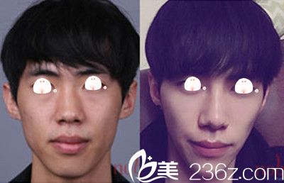 20180803_1533282112224930.jpg 面部輪廓+隆鼻.jpg