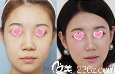 崔圭援院長(zhǎng)隆鼻+瘦臉手術(shù)案例對(duì)比圖 崔圭援院長(zhǎng)隆鼻+瘦臉手術(shù)案例對(duì)比圖