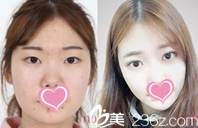 金度焰院長(zhǎng)面部輪廓+雙眼皮手術(shù)案例對(duì)比照