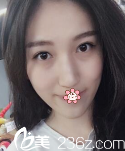 說老實(shí)話，寧夏華美整形美容醫(yī)院何林給我割這雙眼皮才叫真自然！