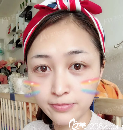 分享我上周在廣州美詩沁做不開刀祛眼袋的手術(shù)經(jīng)歷給大家