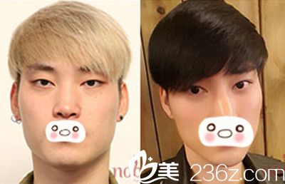 面部輪廓+雙眼皮手術對比效果 面部輪廓+雙眼皮手術對比效果