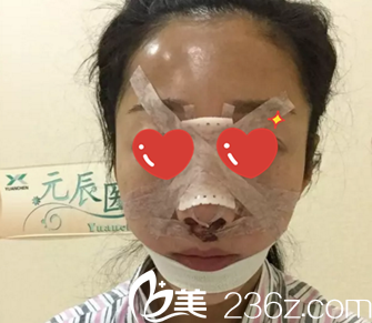 術(shù)后天效果