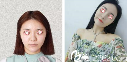 李源錫院長面部埋線提升案例 李源錫院長面部埋線提升案例