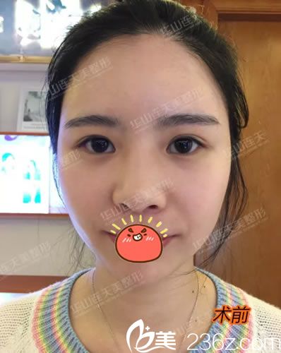 在義烏連天美做雙眼皮手術(shù)前 在義烏連天美做雙眼皮手術(shù)前