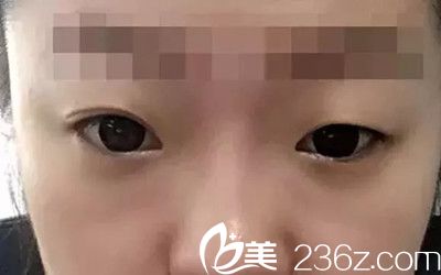 手術(shù)前照片 手術(shù)前照片