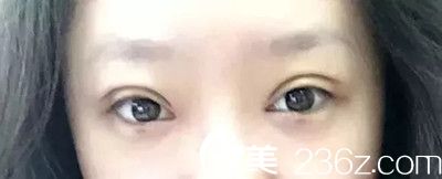 雙眼皮拆線了 雙眼皮拆線了