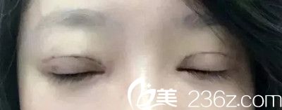 術(shù)后8天 術(shù)后8天