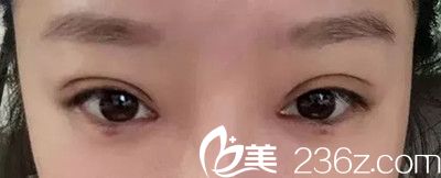 吳偉林醫(yī)生雙眼皮手術(shù)案例 吳偉林醫(yī)生雙眼皮手術(shù)案例