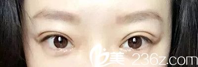 雙眼皮術(shù)后15天恢復(fù)效果 雙眼皮術(shù)后15天恢復(fù)效果