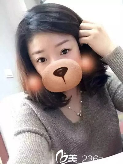 三個(gè)月前在九江星瑞美整形醫(yī)院做了雙眼皮手術(shù)，給大家分享下恢復(fù)情況吧