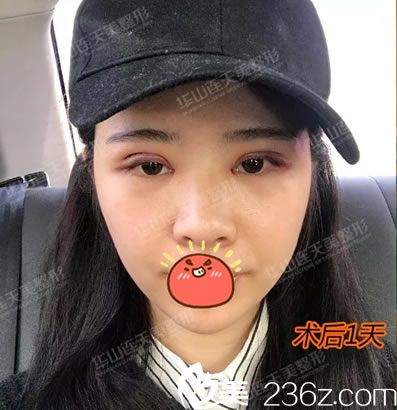 在義烏連天美剛做完雙眼皮照片 在義烏連天美剛做完雙眼皮照片