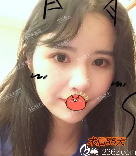 看我55天前選擇義烏連天美割雙眼皮的效果怎么樣,變化大不大?