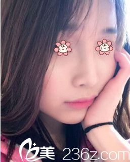 董彭濤鼻綜合術(shù)后一個(gè)月 董彭濤鼻綜合術(shù)后一個(gè)月