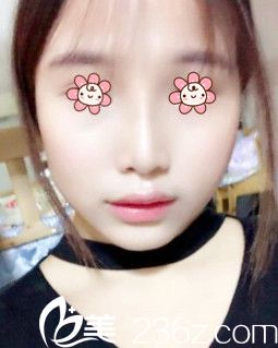 董彭濤假體隆鼻術(shù)后13天 董彭濤假體隆鼻術(shù)后13天