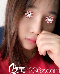 在董彭濤那兒做完膨體隆鼻+鼻綜合發(fā)現(xiàn)寧夏華美整形美容醫(yī)院口碑怎么樣不是迷了。