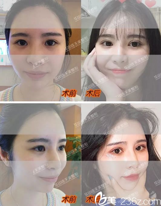 義烏連天美雙眼皮<span style= 義烏連天美雙眼皮<span style=