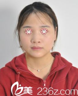 去寧夏華美整形醫(yī)院前我的鼻子 去寧夏華美整形醫(yī)院前我的鼻子
