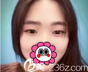 在北京美憬做雙眼皮前樣子 在北京美憬做雙眼皮前樣子