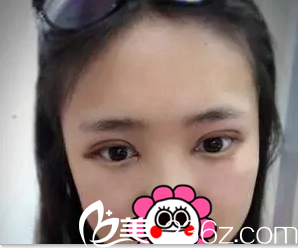 在北京美憬做切開雙眼皮開眼角第4天效果 在北京美憬做切開雙眼皮開眼角第4天效果