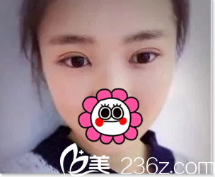 北京美憬閆迎軍雙眼皮案例 北京美憬閆迎軍雙眼皮案例