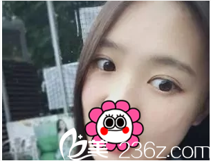 北京美憬閆迎軍雙眼皮案例第37天效果 北京美憬閆迎軍雙眼皮案例第37天效果