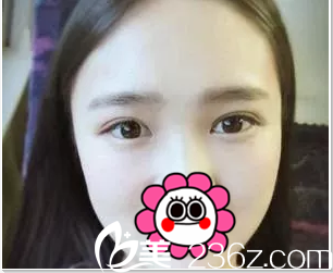 訴說(shuō)我在北京美憬找閆迎軍做切開(kāi)雙眼皮+開(kāi)眼角經(jīng)歷你看這效果咋樣