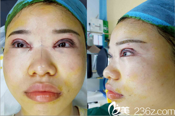 寧波童顏雙眼皮+鼻綜合手術(shù)