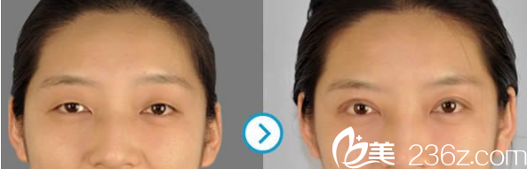 韓國ROCOCO雙眼皮案例