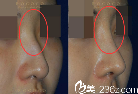 韓國ROCOCO隆鼻案例