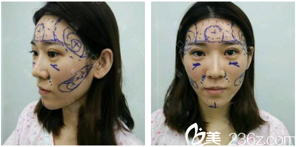 <!--<i data=20240703-sp></i>-->整形醫(yī)院脂肪填充案例術(shù)前照 <!--<i data=20240703-sp></i>-->整形醫(yī)院脂肪填充案例術(shù)前照