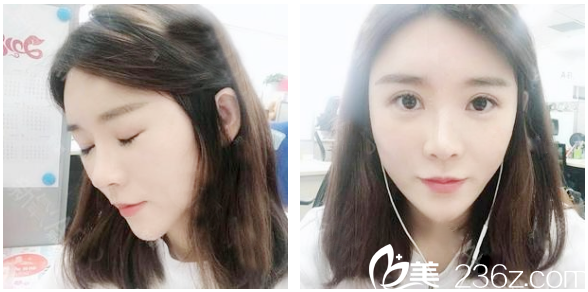 <!--<i data=20240703-sp></i>-->整形醫(yī)院袁野脂肪填充案例術(shù)后一個月圖片 <!--<i data=20240703-sp></i>-->整形醫(yī)院袁野脂肪填充案例術(shù)后一個月圖片