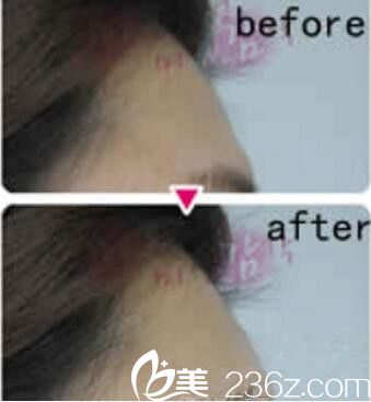 趙得媛脂肪填充額頭真人案例 趙得媛脂肪填充額頭真人案例