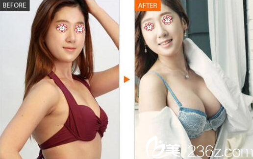 尹盛浩院長胸部整形案例 尹盛浩院長胸部整形案例