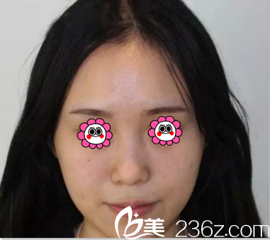 在韓國ROCOCO隆鼻前樣子 在韓國ROCOCO隆鼻前樣子