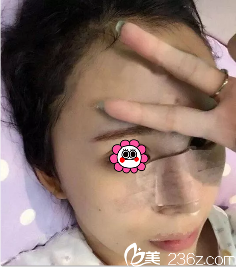 在韓國ROCOCO做隆鼻第2天樣子 在韓國ROCOCO做隆鼻第2天樣子